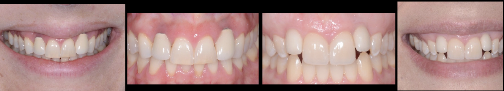 <ul><li><p>pts w vertical growth patterns might have had a prolonged period of facial growth in the vertical plane </p></li><li><p>single tooth implant in a subject w this patter could be placed layer than in a person w a horizontal growth pattern </p></li></ul><p></p>