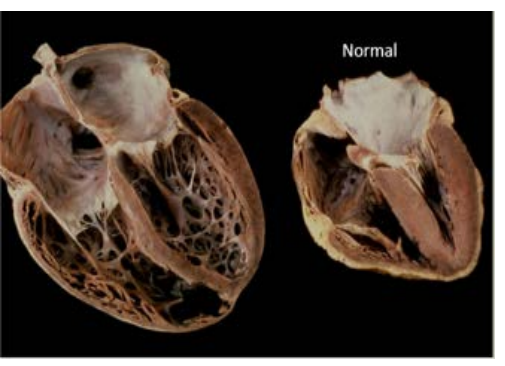 <p>Dilation of the LV or RV</p><p>Causes systolic dysfunction and dilated ventricle</p>
