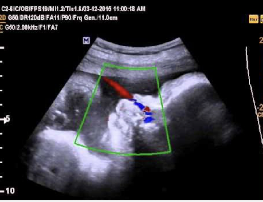 <p>color doppler and obtain a profile view</p>
