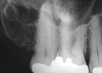 <p>no jaw expansion; NOT pathology, multi-locular RL</p>