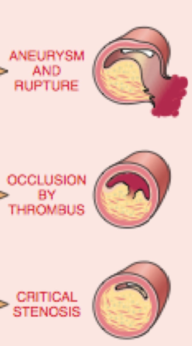 <p>A stationary blood clot along the wall of the blood vessel</p>