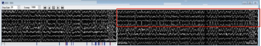 <p>No - we can see a flatlining of response in the odd-numbered electrodes specifically (indicating the change is happening on the ipsilateral side, and constitutes a true EEG change). After the shunt is placed, we can see this reperfusion reflected on the EEG. </p>