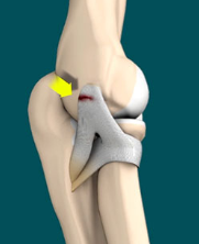 <p><span style="background-color: transparent;"><strong>What is the name of the injury shown in the picture below?</strong></span></p><p></p>