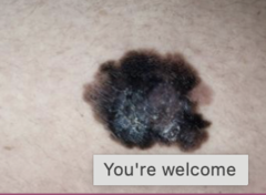 <p>irregularly shaped/pigmented macule, nodule, papule or plaque</p>