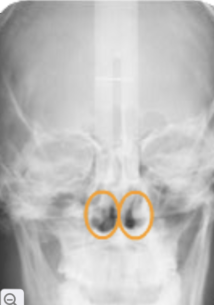 <p>nasal fossa (nasal cavity)</p>