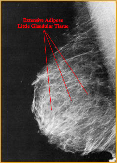 <p>these breasts have a small amount of glandular tissue and extensive adipose tissue</p>