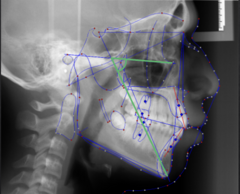 <p>What skeletal measurement:</p><p>- Frankfort Horizontal vs. Sella-Gnathion</p><p>- Vertical relationship between the cranial base and the mandible</p><p>- Tells you about the vertical angulation of the mandible</p>