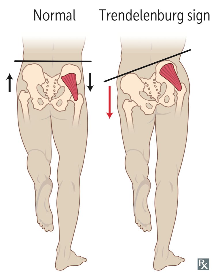 <p>hip drop that occurs when opposite limb is wb could be result of either leg-length discrepancy (shorter side shows dropped hip) or weak-gluteus medius muscle causing short-leg or tredenelenburg gait</p>