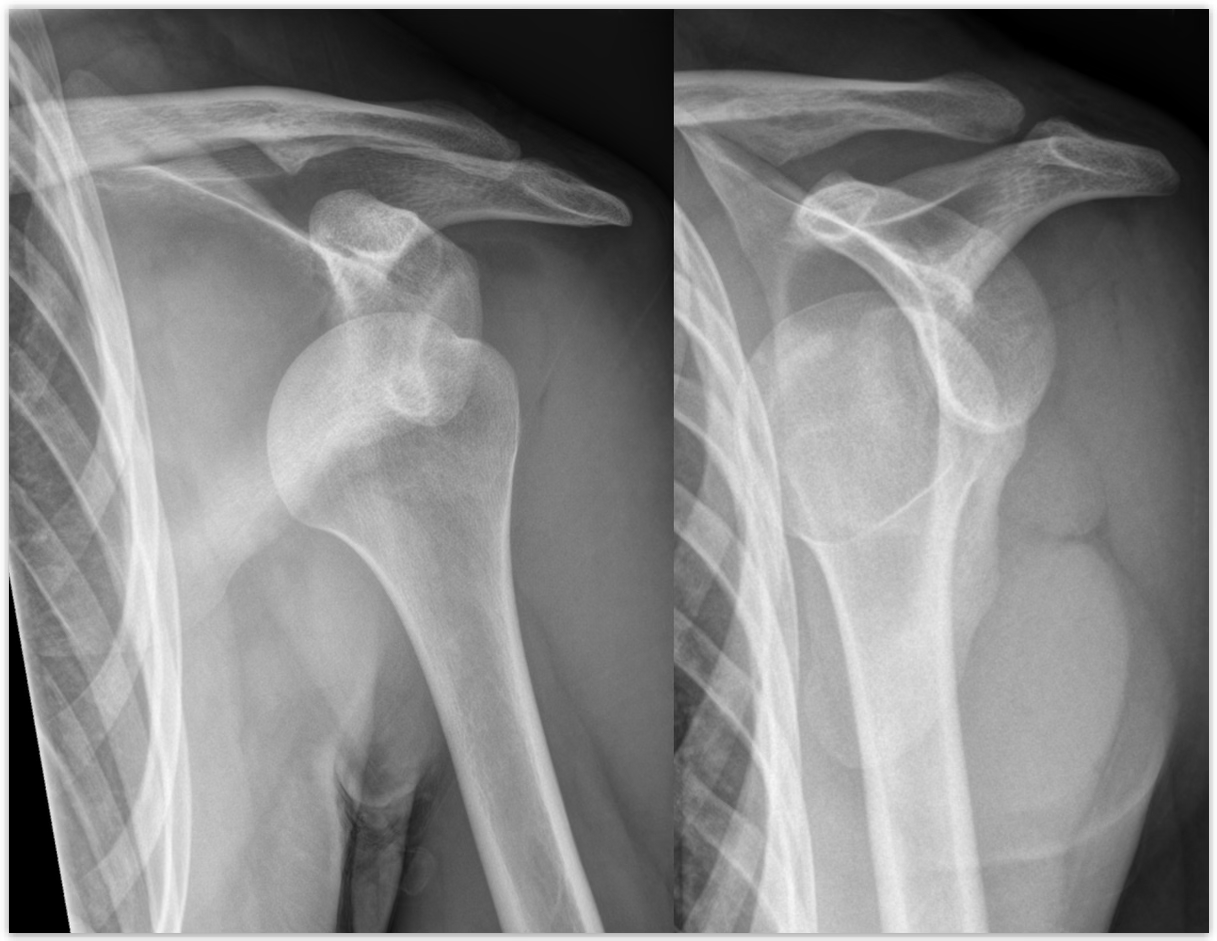 <p>GH Subluxations/Dislocations treatment </p>