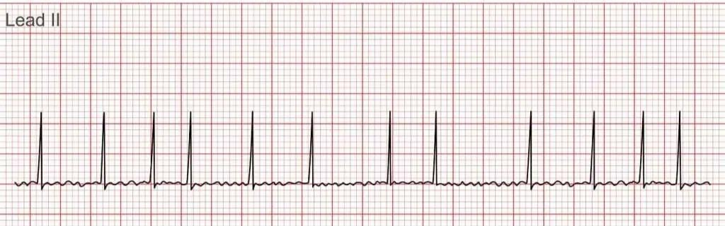 <p>Irregularly irregular </p>