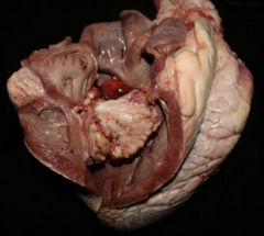 <p>Case: Simmental bull, 2-year-old </p><p>Bull had a large preputial abscess. Weak, tachycardic with arrhythmia, febrile</p><p>Morphologic diagnosis? Marked, locally extensive, acute, suppurative valvular tricuspid endocarditis ▪ Common pathogens?</p>
