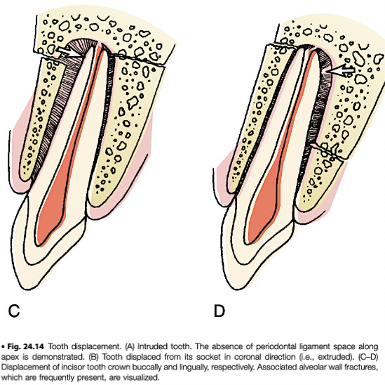 <ul><li><p><span style="color: red;">minimal</span></p><ul><li><p>tooth is <span style="color: red;">slightly displaced</span></p></li><li><p>no alveolar fracture</p></li><li><p><strong>tx:</strong></p><ul><li><p><span style="color: red;">manual repositioning, splinting</span></p></li></ul></li></ul></li><li><p><span style="color: red;">severe</span></p><ul><li><p>tooth is severely displaced <span style="color: red;">with alveolar fracture</span></p></li><li><p><strong>tx:</strong></p><ul><li><p><span style="color: red;">reposition tooth and bone</span></p></li><li><p><span style="color: red;">splinting, suturing</span></p></li></ul></li></ul></li></ul><p></p>