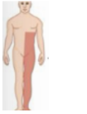 <p><span style="background-color: transparent;"><span>-Contralateral loss of pain, temp, and light touch</span></span></p>
