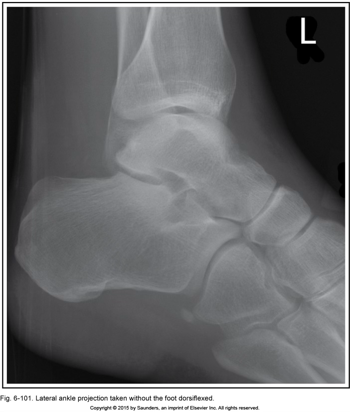 <p>lateral ankle</p>