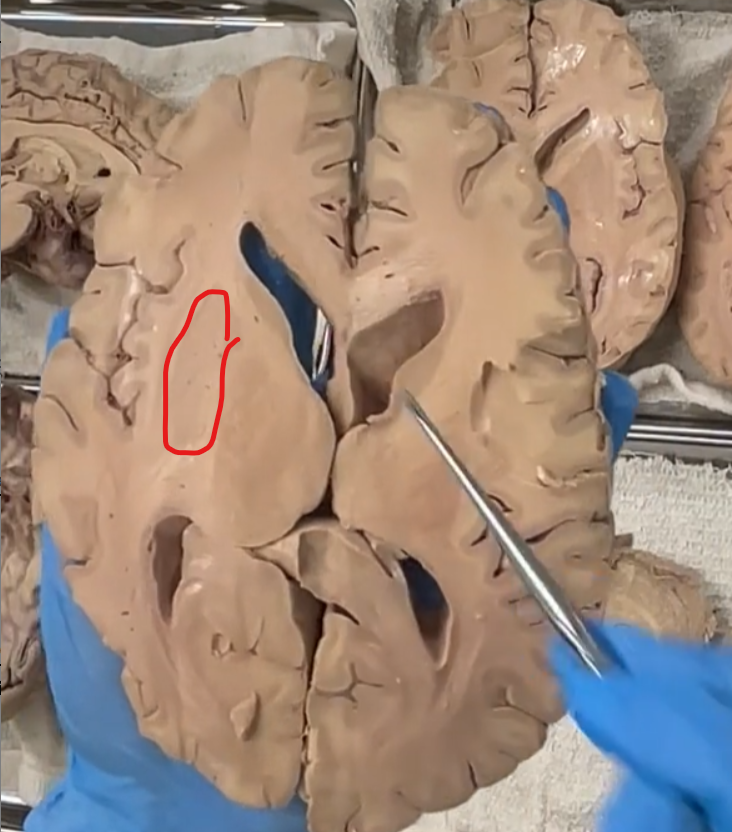 <p>putamen (red)</p><p>the caudate nucleus is separated from the <strong>putamen</strong> by the internal capsule.</p><p><strong>Putamen — Etymology &amp; Definition</strong> </p><p><strong>Etymology</strong> </p><ul><li><p>From Latin <strong><em>putamen</em></strong> = “shell” (like the outer covering of a nut)</p></li></ul><p>So, <strong><em>putamen</em> literally means “shell-like structure.”</strong><br>(This reflects its position as an outer part of the basal ganglia.)</p><p><strong>Definition (Neuroanatomy)</strong> </p><ul><li><p>The <strong>putamen</strong> is:</p><ul><li><p>A <strong>round mass of gray matter</strong></p></li><li><p>Part of the <strong>basal ganglia</strong></p></li><li><p>Located <strong>lateral to the globus pallidus</strong></p></li></ul></li></ul><p><strong>Function (Basal Ganglia Role)</strong> </p><p><strong>Movement regulation (especially execution</strong> and<strong> modulation)</strong></p><ul><li><p>Helps:</p><ul><li><p><strong>Initiate</strong> and<strong> smooth</strong> <strong>voluntary movement</strong></p></li><li><p>Regulate <strong>muscle tone</strong></p></li><li><p>Suppress unwanted movements</p></li></ul></li></ul><p><strong>Functional Circuit</strong> </p><ul><li><p><strong>Receives input </strong>from the <strong>cortex</strong></p></li><li><p>Sends signals to:</p><ul><li><p>globus pallidus</p></li><li><p>Then → thalamus → cortex</p></li></ul></li></ul><p>This loop controls movement precision</p>