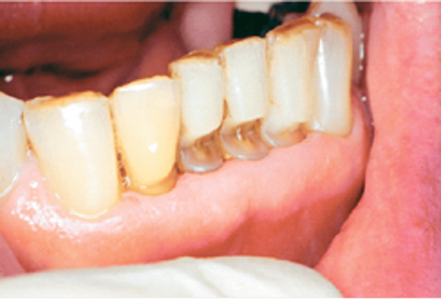 <p>loss of tooth surface in the cervical area, caused by tooth grinding compression forces</p><p><br><span>What are these wedge-shaped defects at the cervicofacial surfaces of these teeth called?</span></p>