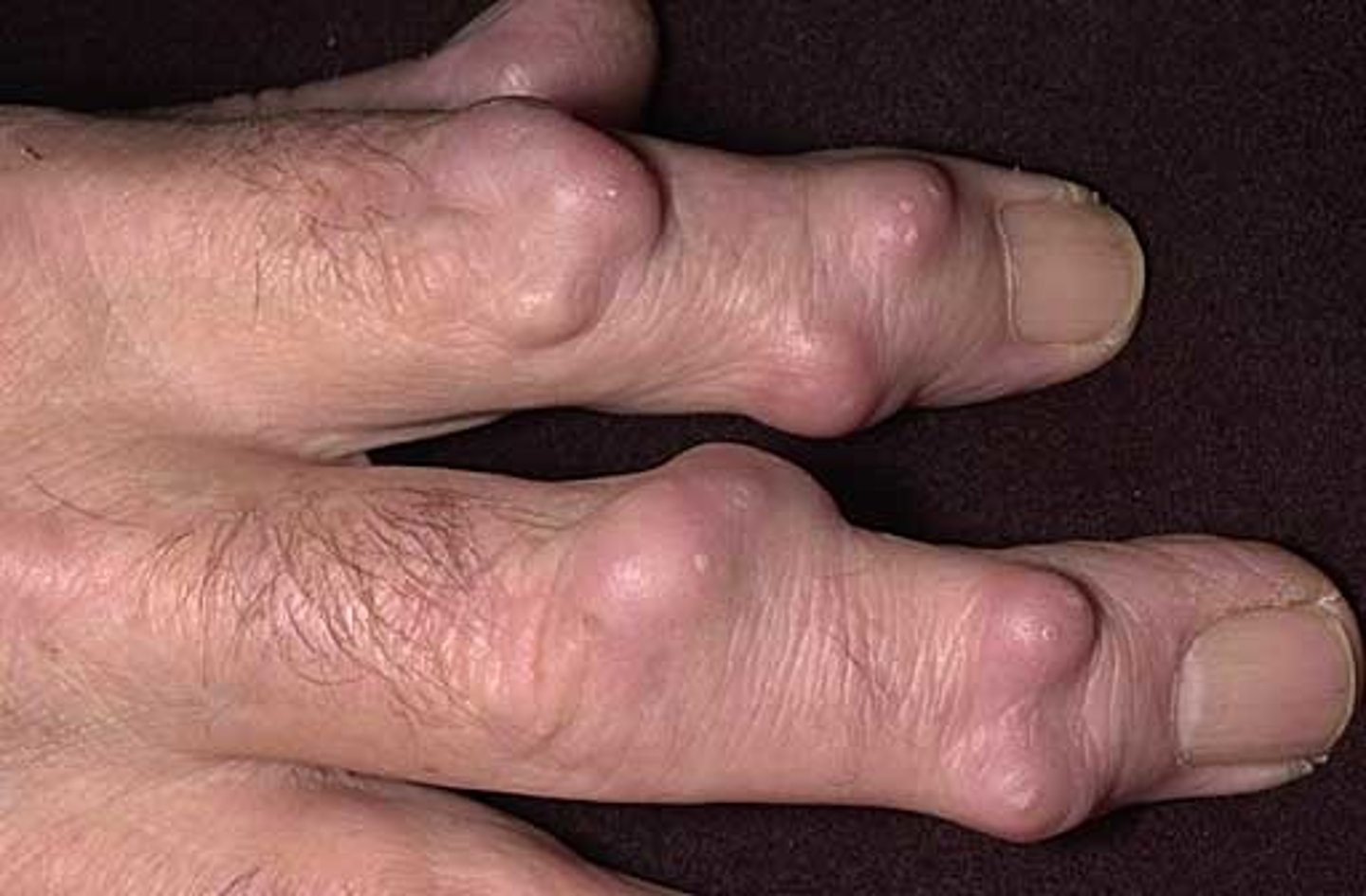 <p>large papule-acne</p>