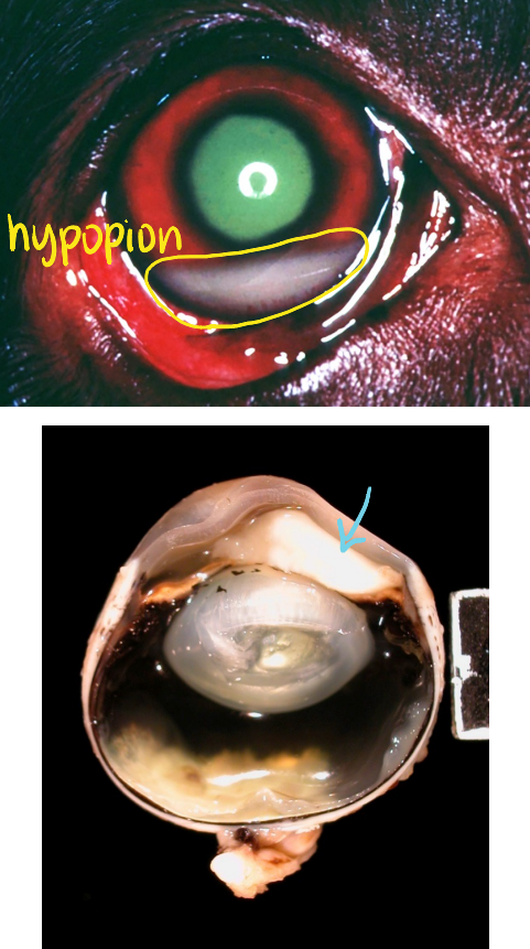 <p>neutrophils (pus) in anterior chamber</p>