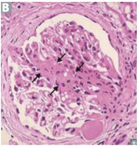 <p>What syndrome?</p>