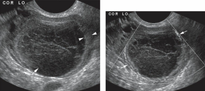 <p>The arrows are pointing to a _____ (thin/ thick) ovarian wall + ______ (think Spider-Man) like lines seen with a ______ cyst </p>