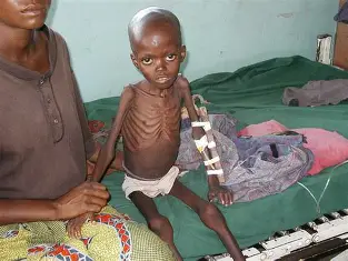 <p>Identify:</p><p>a. Marasmus</p><p>b. Kwashiorkor</p>