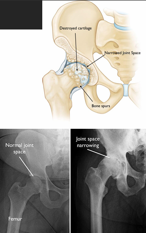 <p><span style="color: red;"><strong>Hip Osteoarthritis</strong></span></p>