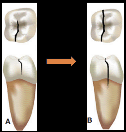 <p>a fx that exists or extends into the root; to include dentin, cementum, and possible pulpal space, which may progress to or from enamel </p>