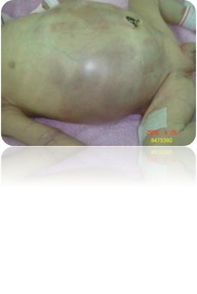 <ul><li><p>abd distention</p></li><li><p>visible bowel loops (can be seen through the skin)</p></li><li><p>bloody stool/ heme positive stool</p></li><li><p>feeding intolerance (don’t feed or they will vomit and aspirate)</p></li><li><p><strong>increased residual (amount of liquid left in stomach)</strong></p></li><li><p>± bilious vomiting</p></li><li><p><strong>lethargy (no nutrition for energy)</strong></p></li><li><p>apnea, bradycardia, oxygen desaturation</p></li><li><p><strong>blood glucose instability (hypoglycemia d/t lack of glucose)</strong></p></li><li><p><strong>temp instability (d/t no fuel for body)</strong></p></li></ul><p></p>
