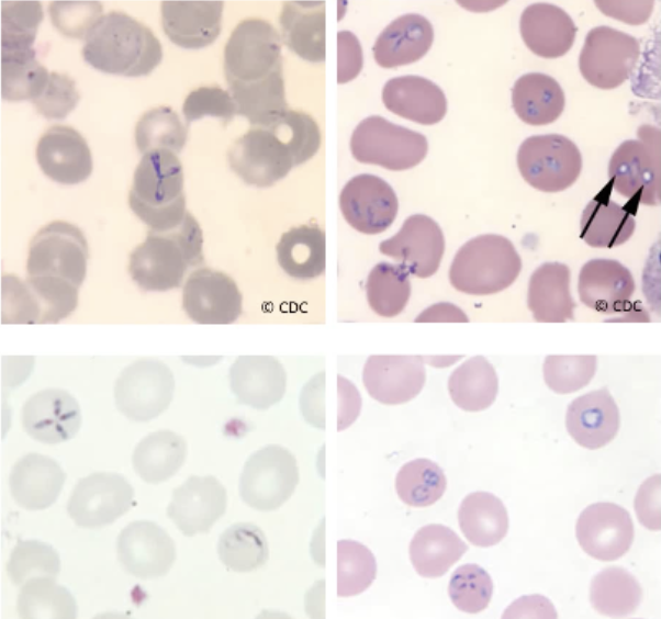 <ul><li><p><span style="background-color: transparent;">The rings of Babesia consists of a small chromatin dots and a scant amount of cytoplasm.</span></p></li><li><p><span style="background-color: transparent;">More mature versions may exhibit two or more chromatin dots.</span></p></li><li><p><span style="background-color: transparent;">Infected red blood cells usually contain 2 to 4 rings.</span></p></li><li><p><span style="background-color: transparent;">The stippling and malarial pigments are absent in Babesia</span></p></li><li><p><span style="background-color: transparent;"><strong><u>multiple rings with center cross-form is diagnostic</u></strong></span></p></li></ul><p></p>