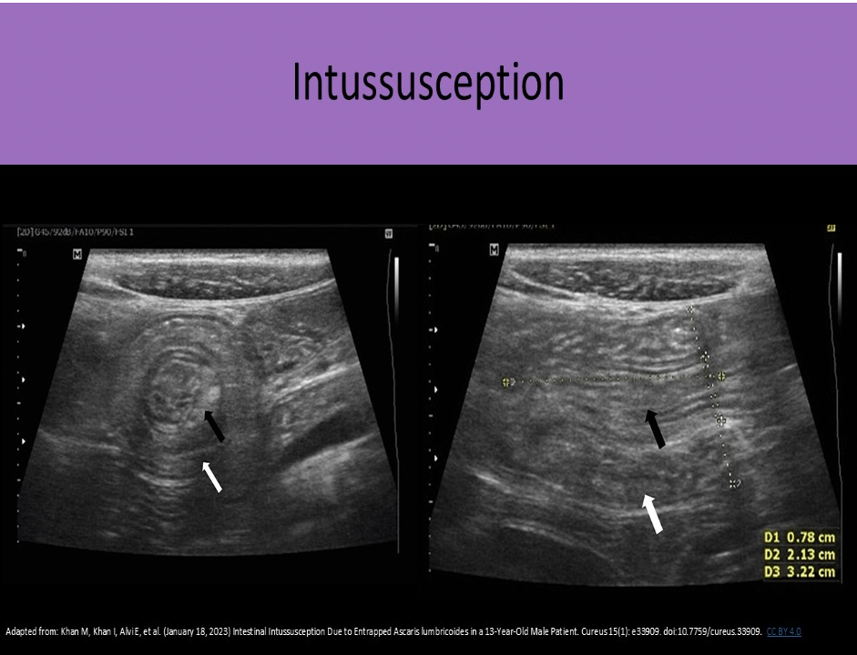<p>A. intussusception</p><p>An intussusception refers to a segment of bowel that involutes into itself. You will see a focal area of concentric rings of bowel that do not persitalse or change shape.</p>