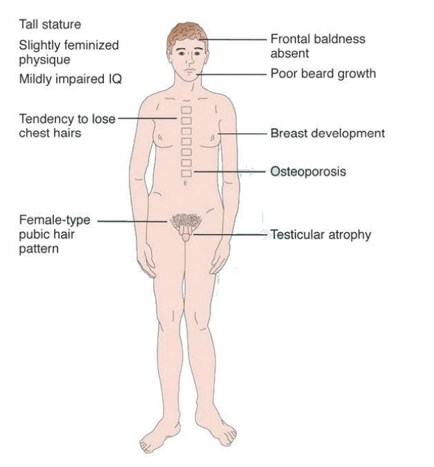 <ul><li><p>Trisomie 2n+1</p></li><li><p>47, XYY</p></li><li><p>Taille supérieure à la Moyenne </p></li><li><p>Troubles de la parole ou des difficultés d'apprentissage </p></li><li><p>troubles émotionnels </p></li><li><p>troubles du comportement tels que le TDAH ou les troubles du spectre autistique.</p></li><li><p>La plupart des hommes atteints de XYY sont fertiles. </p></li><li><p>Les méioses présentent un appariement normal du X avec l'un des Y </p></li><li><p>l'autre Y ne s'apparie pas et n'est pas transmis aux gamètes</p></li></ul><img src="https://assets.knowt.com/user-attachments/f23db605-37b9-4b8b-b817-2aaa53c6c879.png" data-width="100%" data-align="center"><p></p>
