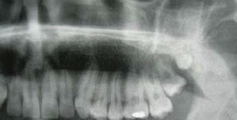 <p>accessory 4th molar </p>