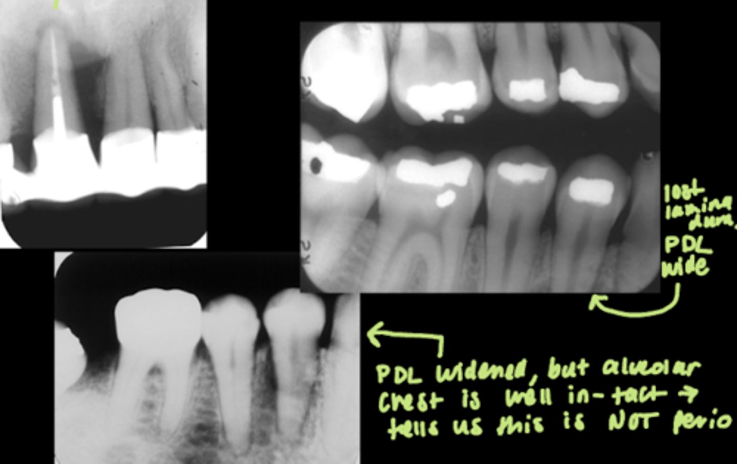 <p>Asymmetric widening of the PDL space and loss of lamina dura can be a sign of a malignant tumor, such as:</p><p>- Osteosarcoma</p><p>- Chondrosarcoma</p><p>- Lymphoma</p>