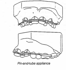 <p>what orthodontic appliance:</p><p>◦ Developed in 1910 by Edward Angle</p><p>◦ Bands on all teeth</p><p>◦ Vertical slots</p><p>◦ Gold archwire has vertical pins soldered for each tooth which are inserted in the vertical slot tubes</p><p>◦ Tooth movement was directed by changing the placement of the pins</p>
