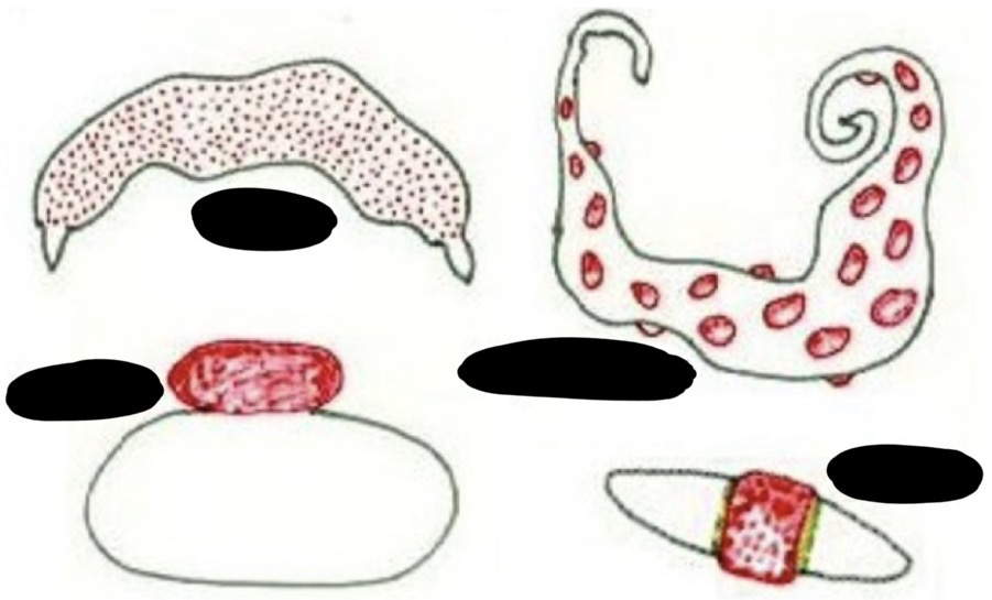 <p>What are the four types of placental shape/contact point classifications? </p>