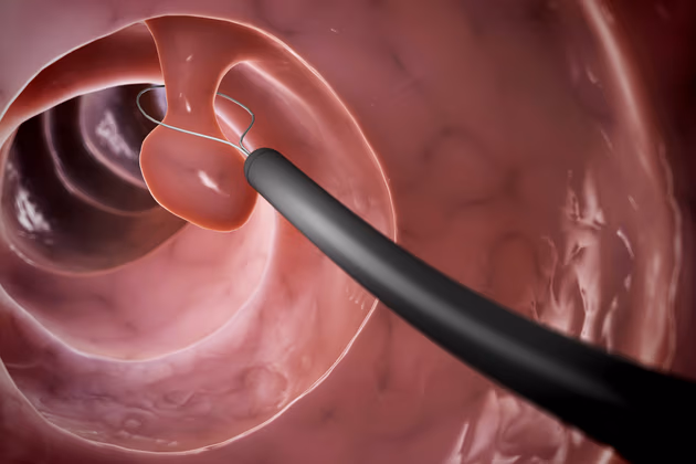 <p>polyp</p>