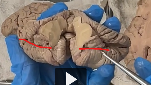 <p>postero-lateral fissures </p>