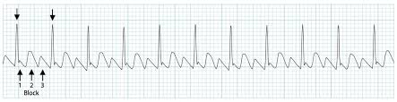 <p>Afib</p><ul><li><p>Irregularly irregular rhythm</p></li><li><p>No discernable P waves, variable ventricular response</p></li><li><p>Risk of thromboembolism</p></li></ul><p></p><p>Aflutter</p><ul><li><p>Sawtooth flutter waves (best seen in leads II, III, aVF)</p></li><li><p>Ventricular rate often REGULAR and FAST (2:1 or 4:1 conduction)</p></li></ul><p></p>