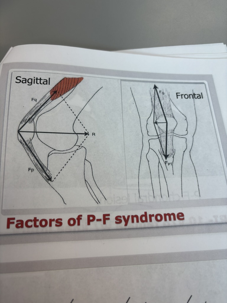 <p>- pain at the patella joint</p>