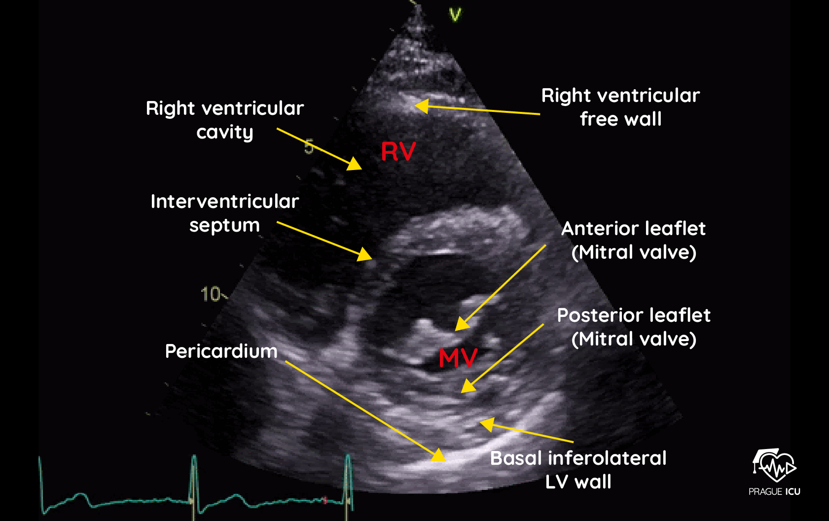 <p><strong>Structures You Should See:</strong></p><ul><li><p>Mitral valve (leaflets)</p></li><li><p>LV</p></li><li><p>RV</p></li><li><p>IVS</p></li></ul><p></p>