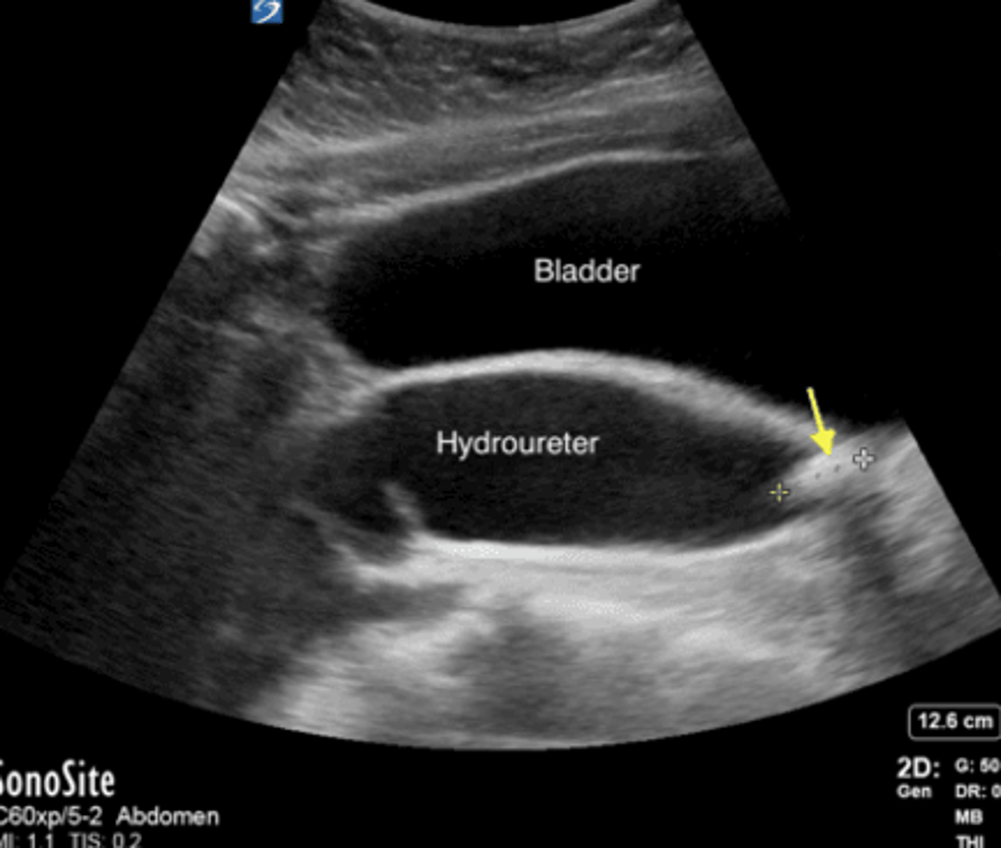 <p>VUR: hydronephrosis and hydroureter</p><p>UPJO: hydronephrosis without hydroureter</p>