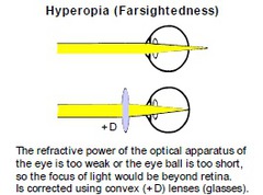 <p>farsightedness - unable to see things that are up close</p>
