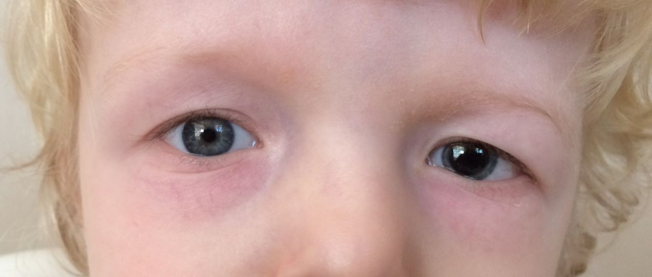 <ol><li><p><span style="color: rgb(154, 166, 39);"><strong>pupillary </strong></span>changes</p></li><li><p><span style="color: rgb(50, 135, 28);"><strong>posturing </strong>(</span><span>Decorticate/Decerebrate)</span></p></li><li><p><span style="color: rgb(212, 71, 215);"><strong>Cheyne-stokes</strong></span> respirations</p></li><li><p><span style="color: rgb(249, 90, 23);"><strong><u>CUSHINGS </u>triad</strong></span></p></li></ol><p></p>