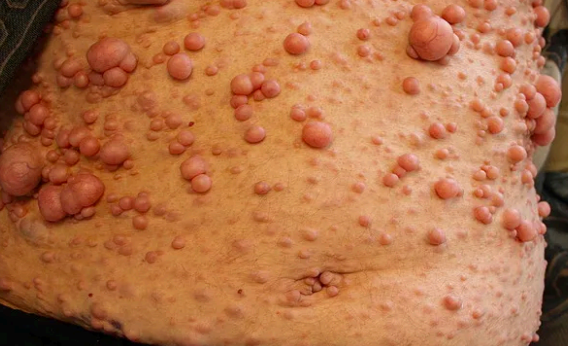<p>multiple neurofibromatosis</p>