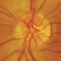 <p>How does the optic nerve appear with posterior optic neuritis?</p>