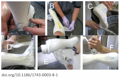 <p>Once the orthotist has determined the configuration and orientation of the subject's anatomy for corrective measures, the limb shape is captured by wrapping a sock and casting the leg (Figure A,B) </p><p>Once the cast has set it is cut away along the anterior contour (Figure C). </p><p>Plaster is poured into the leg cavity. Key surfaces are built outwards with plaster by embedding staples corresponding to surface markers (Figure D). </p><p>Pre-heated thermoplastic is vacuum formed around the plaster (Figure E). Once cool, the unwanted plastic is cut away, and edges on the AFO are ground down & smoothed (Figure F). </p><p>Due to warehousing considerations, most leg busts in clinics are not kept for more than typically 2 months, so for each patient refitting (typically occurring every other year), the whole process must start from the beginning</p>