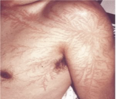 <p>caused by electrical current spread along the skin where resistance is low</p><p>the "burn" is a result of cutaneous imprints</p><p>from electron showers that track the skin and develop a fern like pattern with branches.</p>