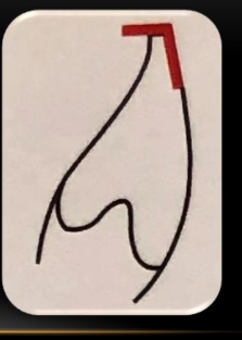 <p>1) posteriors must be gotten out of the way in order to see how anteriors couple</p><p>2) the lower incisal edge should have a definite labio-incisal angle</p>