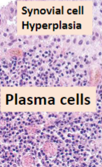 <p>Rheumatoid Arthritis </p>