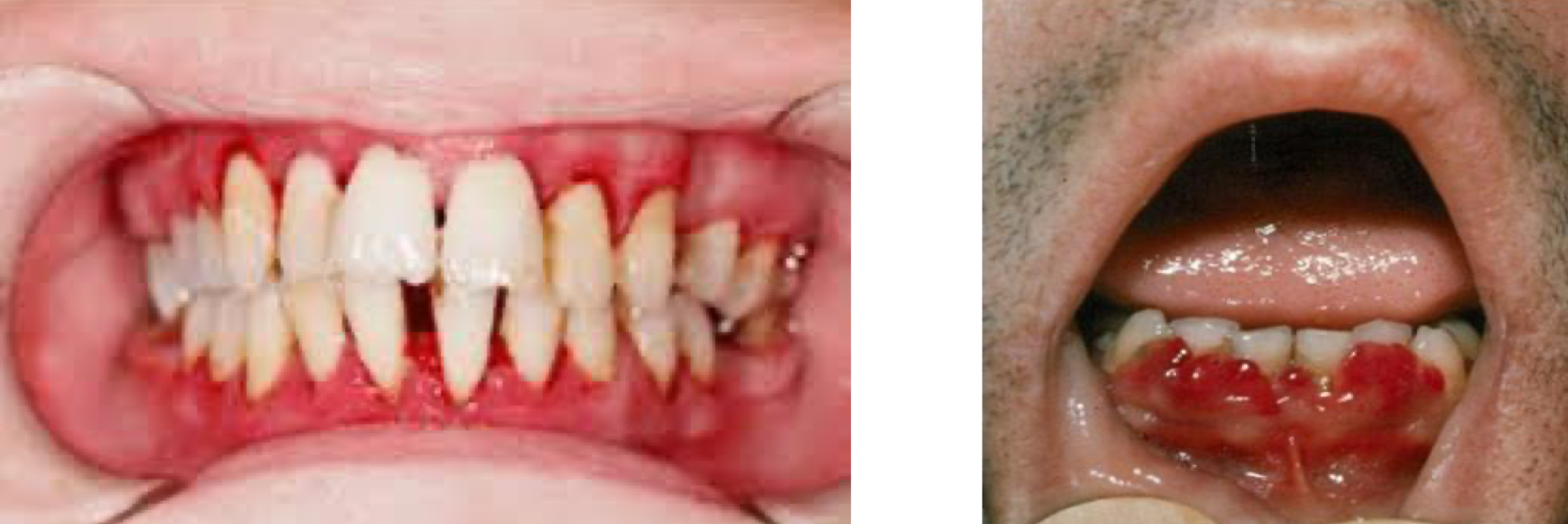 <ul><li><p>Edematous, spongy gingiva with non-specific appearance </p></li><li><p>Spontaneous bleeding, impaired wound healing </p></li><li><p>Managed by treating deficiency and plaque control</p></li></ul><p></p>